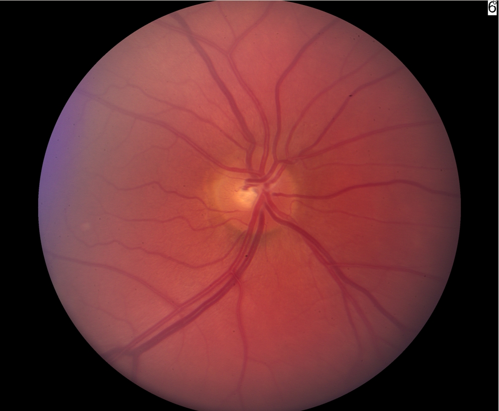normal optic nerve